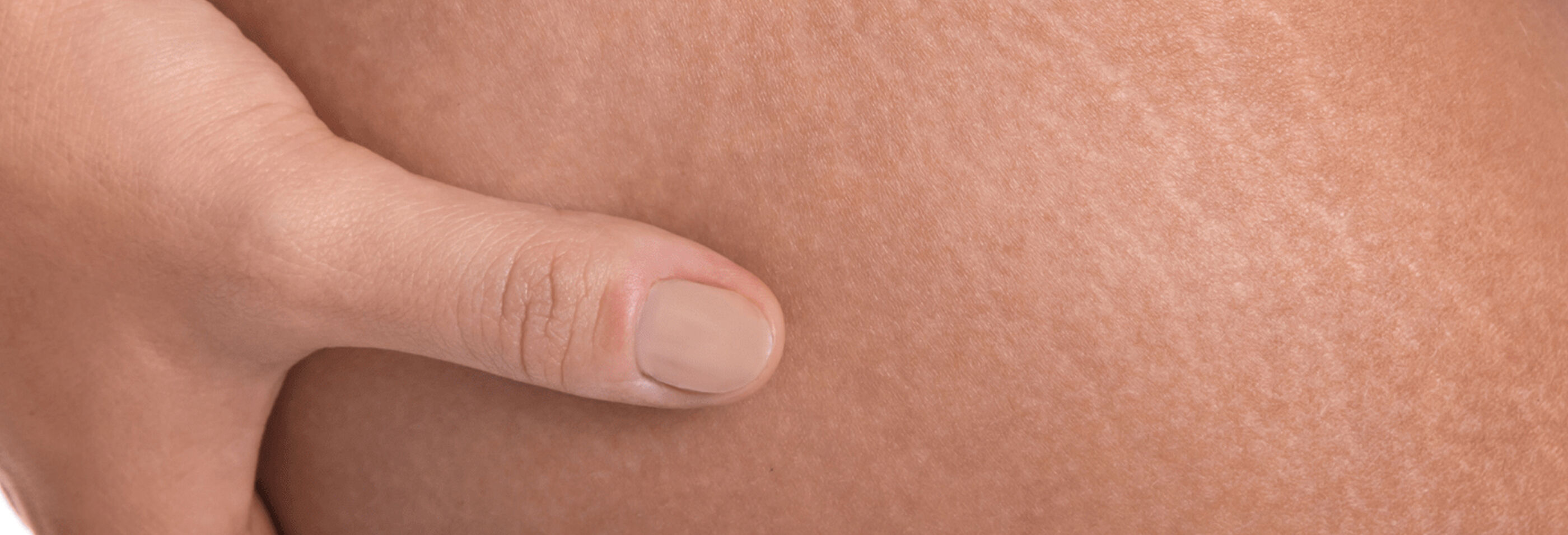 Vergetures c'est quoi 